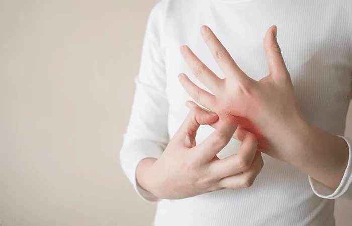 pessoa coçando a mão por conta de uma reação alérgica