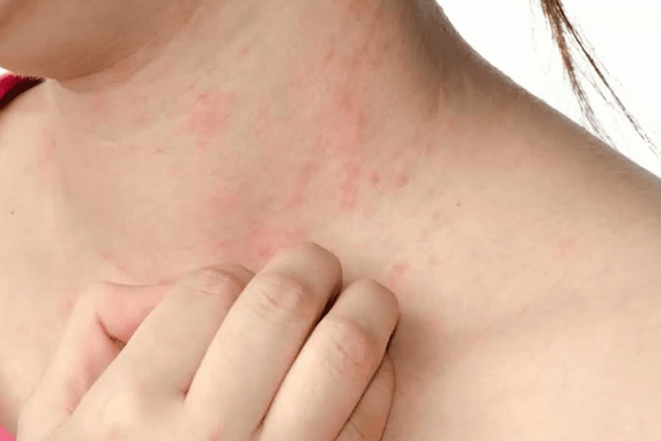 mancha vermelha na pele fotos alergia