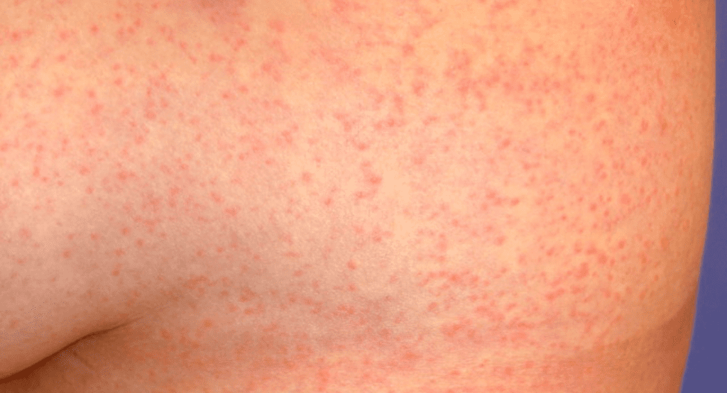 manchas vermelhas na pele foros zika vírus