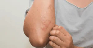 Pessoa com alergia a água