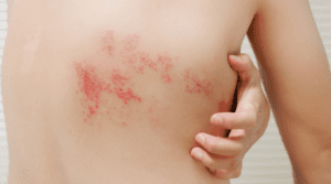 Pessoa com herpes zoster
