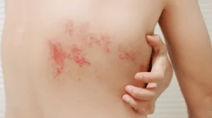 Pessoa com herpes zoster