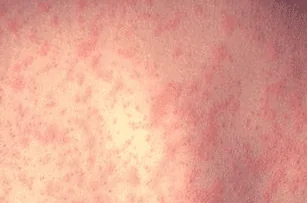 Foto de manchas de dengue