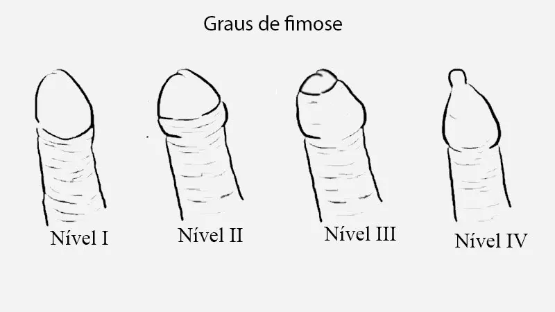 Diferentes graus de fimose dentre os tipos