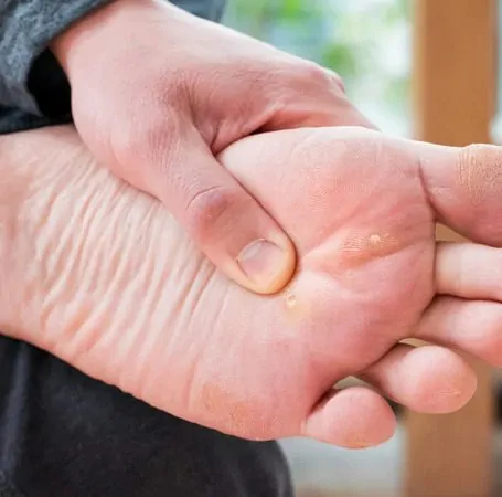 Uma pessoa segurando o pé e mostrando olho de peixe