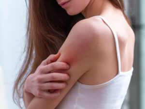 Mulher precisando de remédio caseiro para alergia na pele