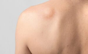 Pessoa com lipoma nas costas