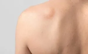 Pessoa com lipoma nas costas