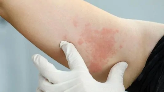 pessoa com alergia a suor