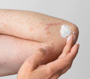 Mulher passando antialérgico para coceira no corpo