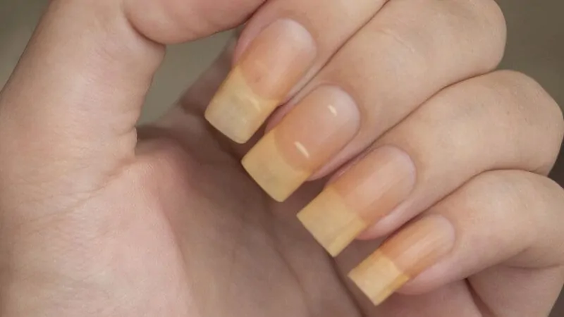 foto de uma mão com as unhas amareladas