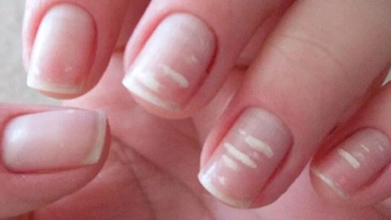 imagem de uma mão com as unhas com manchas brancas
