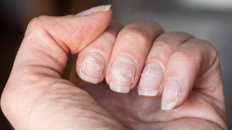 imagem de uma mão com unhas fracas e moles