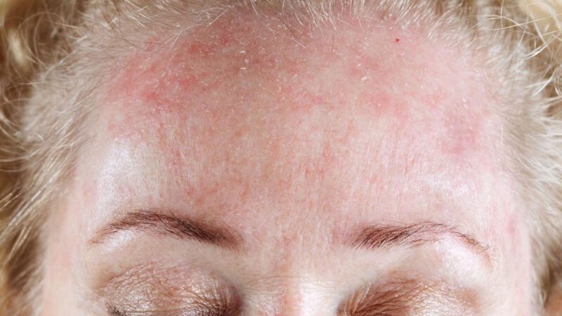 imagem de uma mulher com manchas no rosto causadas pela dermatite seborreica