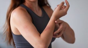 Uma mulher com muitas manchas roxas no corpo