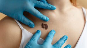 Pessoa sofrendo com manchas escuras na pele