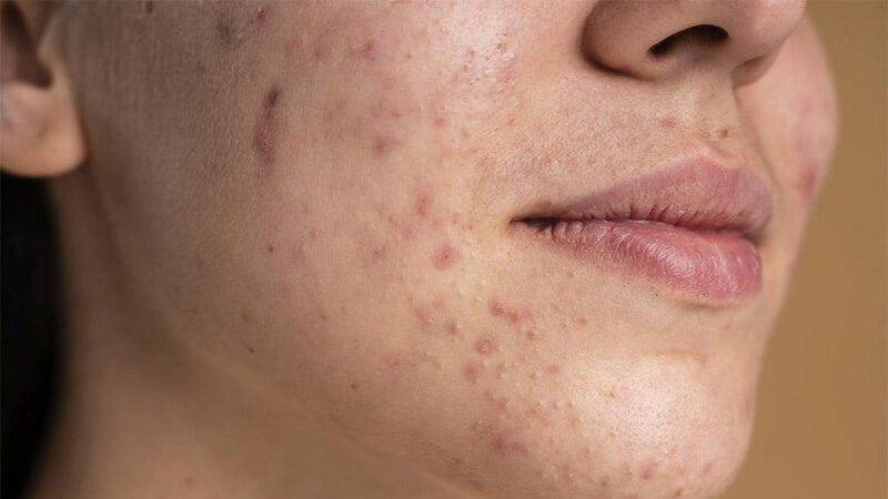 imagem de uma mulher com manchas na pele causadas pela acne