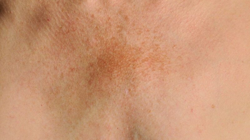 imagem de mancha na pele devido ao melasma