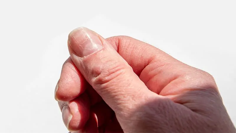 imagem de uma mão com as unhas com linhas verticais