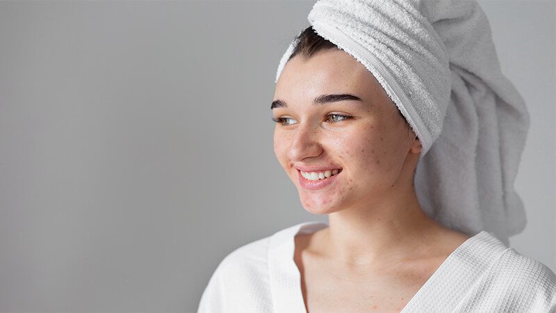 imagem de uma mulher com acne no rosto sorrindo