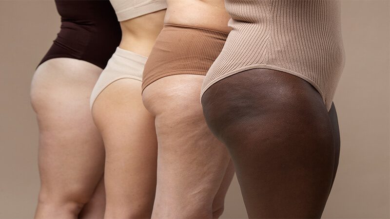 Imagem de quatro mulheres com celulites nas pernas