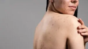 Imagem de uma mulher com foliculite