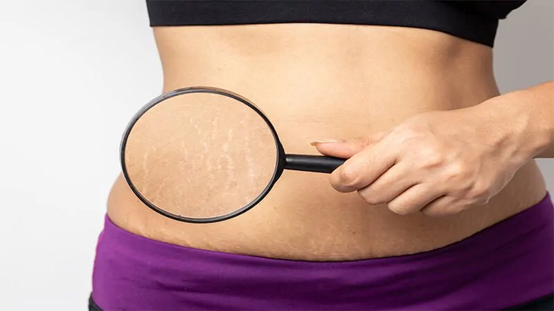 Imagem de uma mulher com estrias na barriga