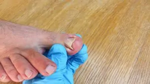 imagem de um pé com a unha encravada