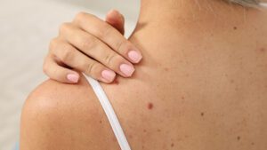 imagem de uma mulher após usar remédio caseiro para tirar sinais da pele