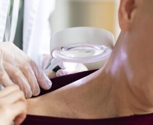 Mulher recebendo autocuidados para furunculo