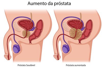 Aumento da próstata ilustração
