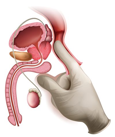 Ilustração de como é o exame de próstata toque