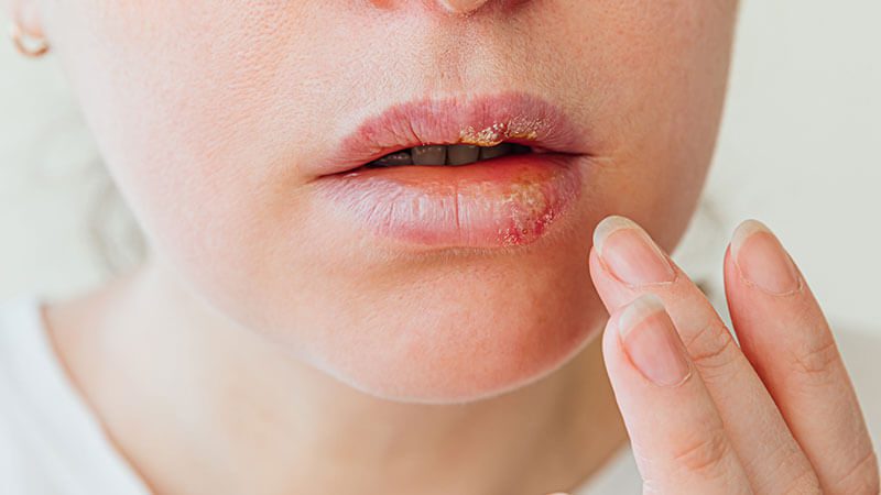 imagem de uma mulher com a mão na boca aplicando pomada para secar herpes labial