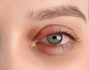 Mulher ao acordar com olho grudado de remela