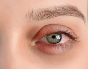 Mulher ao acordar com olho grudado de remela