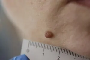 Paciente com verruga