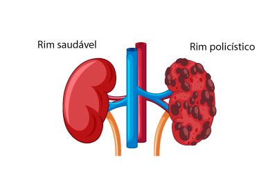 Representação de rim saudável e rim policístico