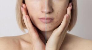 Mulher precisando de creme clareador de pele