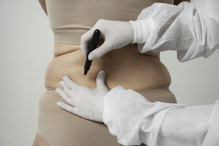 Mulher precisando de cirurgia de lipoma