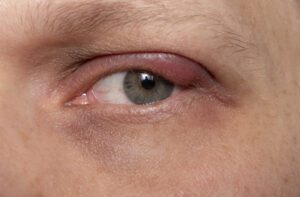 Autocuidados para terçol