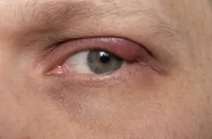 Autocuidados para terçol